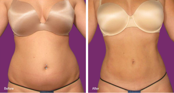 Body Shaping Liposuction Surgery