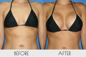 breast-enlargement-surgery